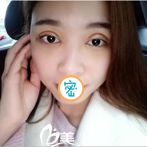 雙眼皮+開眼角術后8天腫脹比較厲害 雙眼皮+開眼角術后8天腫脹比較厲害