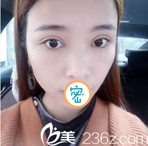 綿陽茗匯雙眼皮+開眼角術后半個月 綿陽茗匯雙眼皮+開眼角術后半個月