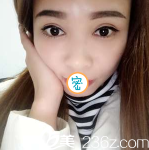 切開雙眼皮+開眼角術后化妝照 切開雙眼皮+開眼角術后化妝照