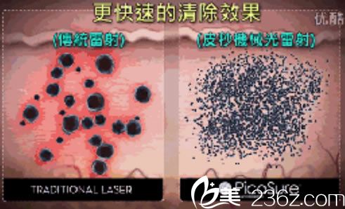 皮秒祛斑祛斑<span style=