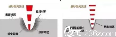 超皮秒祛斑治療速度優(yōu)勢(shì)