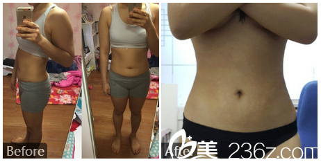 深圳貝漾美馮衛(wèi)醫(yī)生腰腹部抽脂案例對比圖 深圳貝漾美馮衛(wèi)醫(yī)生腰腹部抽脂案例對比圖