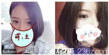 深圳貝漾美馮衛(wèi)醫(yī)生做的雙眼皮案例 深圳貝漾美馮衛(wèi)醫(yī)生做的雙眼皮案例