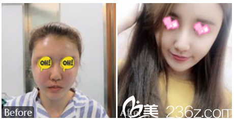 深圳貝漾美馮衛(wèi)醫(yī)生做的面部脂肪填充案例 深圳貝漾美馮衛(wèi)醫(yī)生做的面部脂肪填充案例