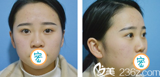 達州雙均玻尿酸隆鼻術前照 達州雙均玻尿酸隆鼻術前照