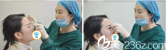 達州雙均李易蔓注射玻尿酸隆鼻 達州雙均李易蔓注射玻尿酸隆鼻