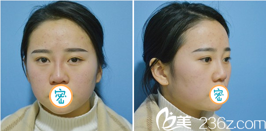 李易蔓玻尿酸隆鼻術后即刻效果 李易蔓玻尿酸隆鼻術后即刻效果