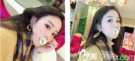 玻尿酸隆鼻+瘦臉術后7天效果 玻尿酸隆鼻+瘦臉術后7天效果