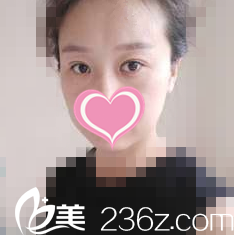 術(shù)前雙眼皮失敗的樣子 術(shù)前雙眼皮失敗的樣子