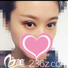 雙眼皮修復(fù)一周效果 雙眼皮修復(fù)一周效果