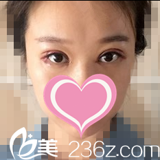 雙眼皮修復(fù)術(shù)第三天 雙眼皮修復(fù)術(shù)第三天