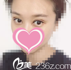 雙眼皮修復(fù)半個月樣子 雙眼皮修復(fù)半個月樣子