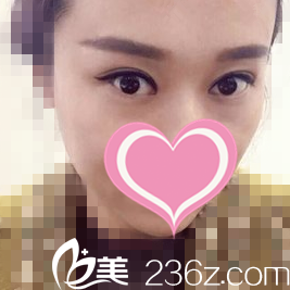 修復(fù)雙眼皮一個月效果 修復(fù)雙眼皮一個月效果