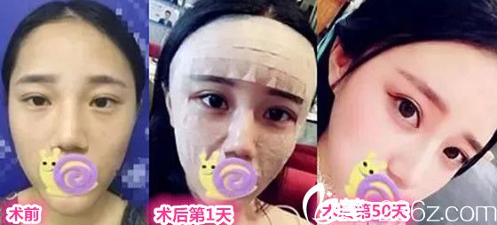 銅陵晶美整形美容醫(yī)院石良兵院長面部自體脂肪填充案例前后對比圖 銅陵晶美整形美容醫(yī)院石良兵院長面部自體脂肪填充案例前后對比圖