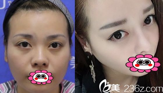 找銅陵晶美整形美容醫(yī)院石良兵做鼻綜合隆鼻案例 找銅陵晶美整形美容醫(yī)院石良兵做鼻綜合隆鼻案例