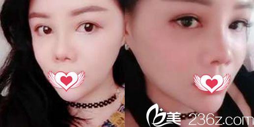 銅陵晶美石良兵院長給我做隆鼻失敗修復(fù)+不明注射物出案例 第22天就迫不及待曬圖