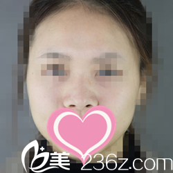 鼻綜合術前照 鼻綜合術前照