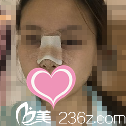 鼻整形術后第五天狀況 鼻整形術后第五天狀況