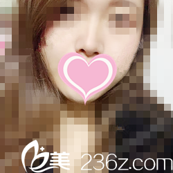 術后一個月情況 術后一個月情況