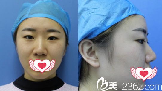 未去合肥壹加壹整形美容醫(yī)院做全切雙眼皮之前樣子 未去合肥壹加壹整形美容醫(yī)院做全切雙眼皮之前樣子