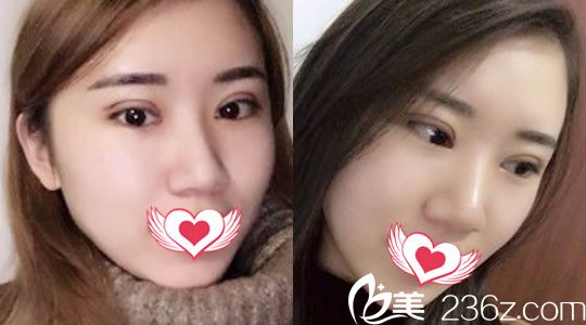 找合肥壹加壹整形外科醫(yī)院甘泉涌割雙眼皮第3天恢復(fù)情況圖 找合肥壹加壹整形外科醫(yī)院甘泉涌割雙眼皮第3天恢復(fù)情況圖