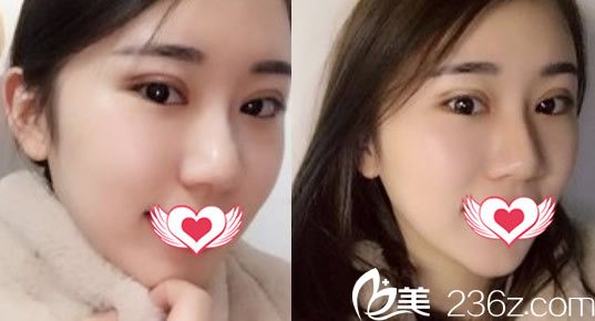 合肥壹加壹整形美容醫(yī)院甘泉涌全切雙眼皮整形案例術(shù)后第6天拆線后樣子 合肥壹加壹整形美容醫(yī)院甘泉涌全切雙眼皮整形案例術(shù)后第6天拆線后樣子