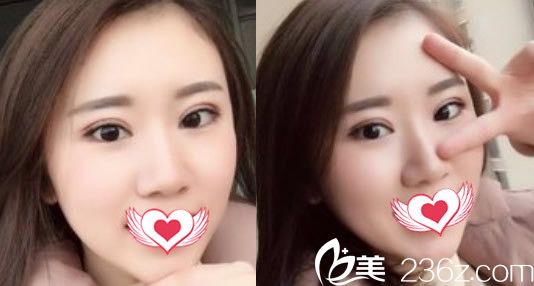 去合肥壹加壹整形美容醫(yī)院割雙眼皮術(shù)后第9天效果展示 去合肥壹加壹整形美容醫(yī)院割雙眼皮術(shù)后第9天效果展示