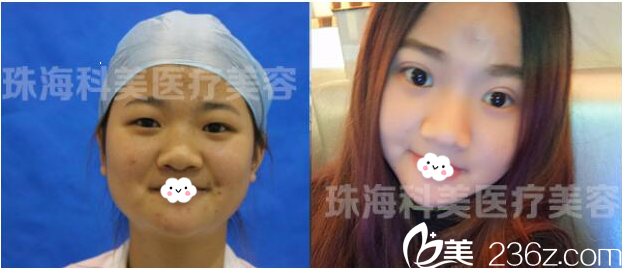 珠?？泼勒吾t(yī)院張民望院長切開雙眼皮案例