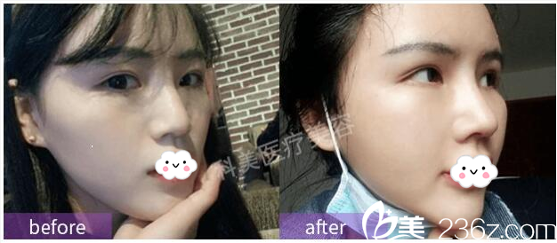 珠?？泼缽埫裢洪L做的假體隆鼻案例