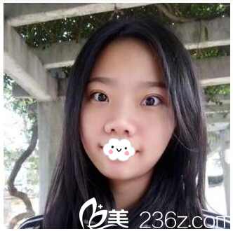 給你們瞧瞧我找珠?？泼勒吾t(yī)院張民望院長做的雙眼皮效果如何