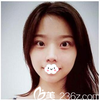 做完雙眼皮23天的我