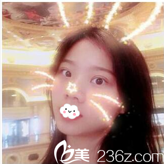 珠?？泼缽埫裢p眼皮15天效果