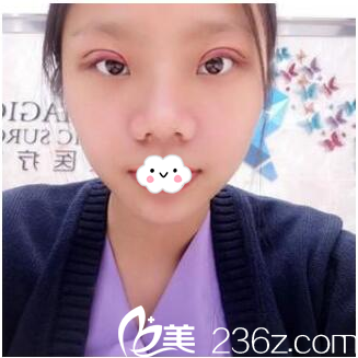 珠?？泼缽埫裢洪L雙眼皮做完第二天