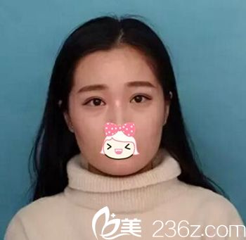 瘦臉注射前 瘦臉注射前