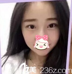 瘦臉注射后3天 瘦臉注射后3天