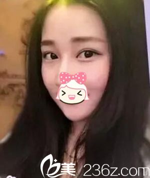 瘦臉注射后7天 瘦臉注射后7天