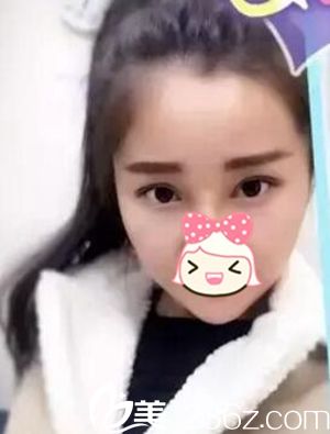 瘦臉注射后15天 瘦臉注射后15天