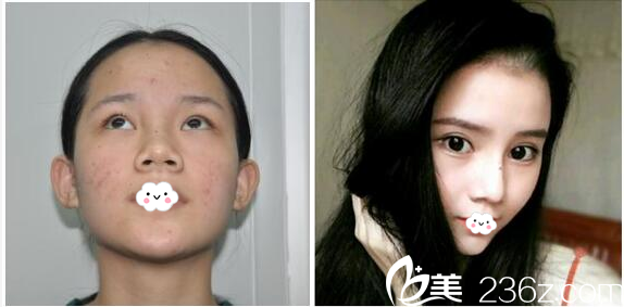 深圳微姿康壯為雙眼皮和隆鼻<span style=