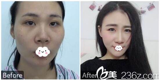 深圳微姿康壯為脂肪填充和隆鼻<span style=