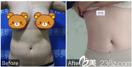 深圳微姿羅秋雄腰腹部抽脂<span style=