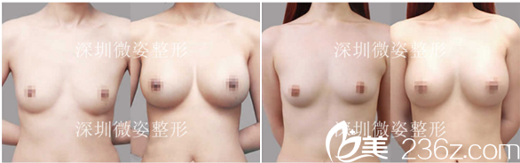 深圳微姿康壯為做的脂肪隆胸<span style=