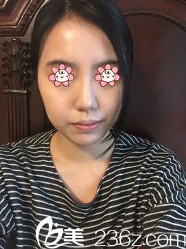 <!--<i data=20240703-sp></i>-->張凱鼻綜合術后半個月 <!--<i data=20240703-sp></i>-->張凱鼻綜合術后半個月