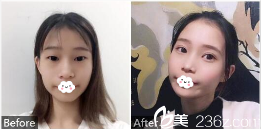 汕頭曙光殷運(yùn)成做的雙眼皮和開眼角案例