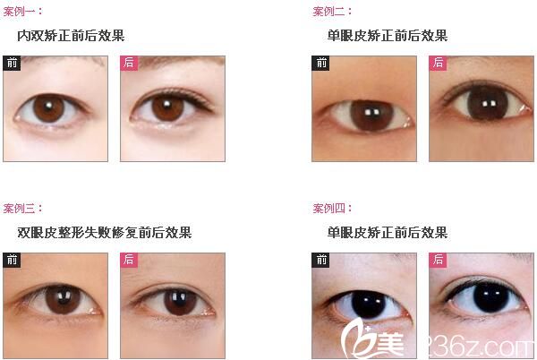 大小眼怎么辦？南寧慧美雙眼皮手術(shù)9800元起幫你塑造美眼