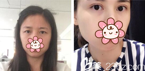 樸秀萬院長眼部整形案例 樸秀萬院長眼部整形案例