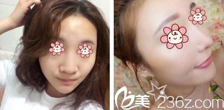 徐仁洙院長鼻整形案例 徐仁洙院長鼻整形案例