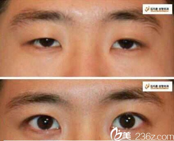 金志薰院長(zhǎng)雙眼皮手術(shù)案例 金志薰院長(zhǎng)雙眼皮手術(shù)案例