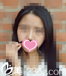 找韓國博樂絲整形醫(yī)院鄭載用做的硅膠隆鼻效果真不錯(cuò)，我很喜歡！