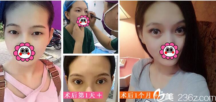 董磊院長雙眼皮真人案例