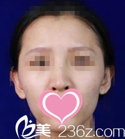 術(shù)前照片 術(shù)前照片